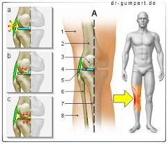 Es entsteht vor allem durch Schmerzen Im Knie Was Habe Ich