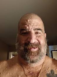 Before and after hair cut and beard trim. You can see some of the tumors