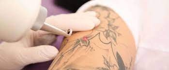 We also provide hair removal services for both. Laser Tattoo Removal Richmond Mechanicsville Va