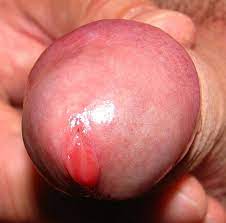 File Penis Glans Man 2 Jpg Wikimedia Commons