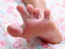 So you can do treatment and you will get very good results provided you take care of. Childhood Rashes Skin Conditions And Infections Photos Babycenter Australia