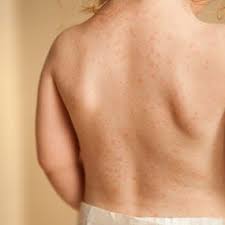 Pictures Of Skin Allergies In Children Skin Allergies Asthma Treatment Skin Rashes Pictures