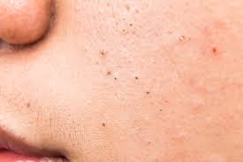 Blackhead adalah komedo hitam, masalah kulit umum yang mungkin pernah dialami oleh sebagian besar orang. Penyebab Munculnya Komedo Hitam Di Wajah Dan Cara Mengatasinya Alodokter