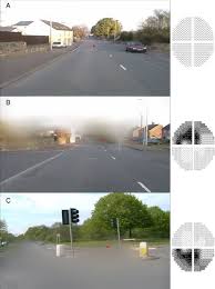 Image result for Visual Field Deficit