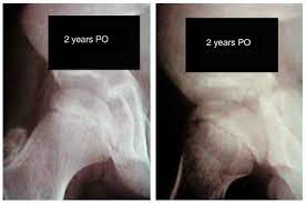 Scielo Brasil Initial Experience Of Use Of An Articulated External Fixator In Treating Legg Calve Perthes Disease By Means Of Arthrodiastasis During The Active Phase Of The Disease Initial Experience Of Use