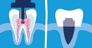 Maybe you would like to learn more about one of these? Root Canal Procedure Or Dental Implant Procedure