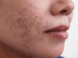 Image result for Diffuse Hyperpigmentation