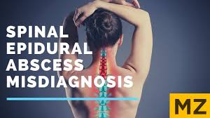 Image result for Spinal Epidural Abscess