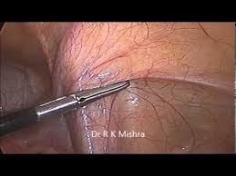What is the collateral circulation after hypogastric artery ligation? Laparoscopic Demonstration Of Pelvic Anatomy Youtube