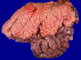 Crystals may appear white or tan and chalky or crumbly. Webpathology Com A Collection Of Surgical Pathology Images