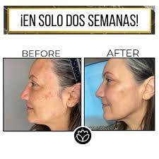 Manchas por el sol, el embarazo, el acné o el tiempo? ¿Cansado de buscar  soluciones y no encontrarlas? Tenemos la solución para ti. 🙌🏼 Hoy puedes  eliminar las machas con el Tratamiento