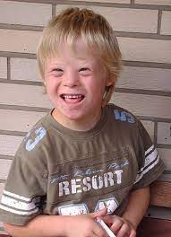 Down Syndrome Wikipedia