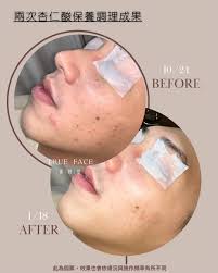 台中西區做臉- 清粉刺不推銷美容無壓力| 蓁妍室