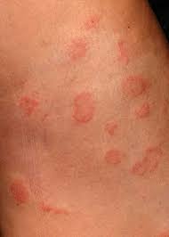 Image result for Skin Infection