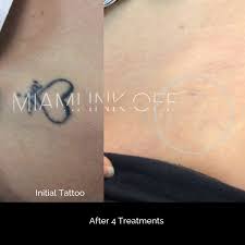 Our tattoo removal doctor at the miami center for dermatology provides laser tattoo removal using the latest technology. Tattoo Removal In Miami Pain Free Laser Treatment Miami Ink Off