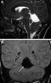 Arachnoid Cyst In A 27 Year Old Woman With Headache And Dizziness Download Scientific Diagram
