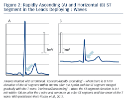 Image result for Early Repolarization