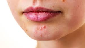 Como Tratar Y Como Eliminar El Acne En La Barbilla Con Distintos Remedios