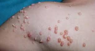 Ingrown hairs are a result of hair removal gone awry. Ingrown Hair How To Get Rid Of Vaginal Ingrown Hair