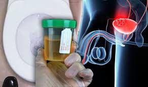 Cancers that develop in the uterus are types of sarcomas. Bladder Cancer Symptoms Urine Signs When Using The Toilet Express Co Uk