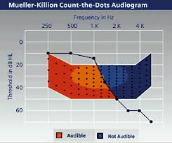 Wireless Technology In An Open Ear Solution Hearing Review