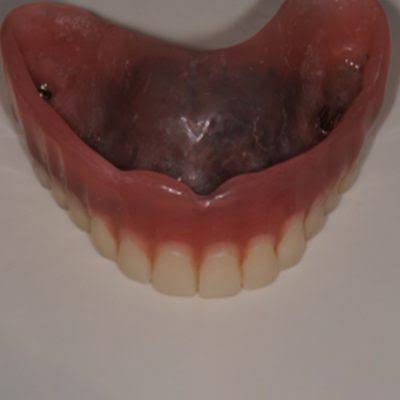 Full Arch Teeth Implants – upper jaw - Mount Elizabeth Dental Surgery™