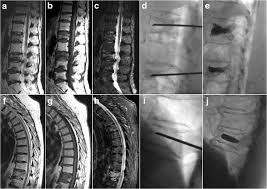 Image result for Vertebral Compression Fracture