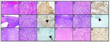 Mesothelioma is an increasingly frequent malignancy in which diagnosis is often delayed and disease diagnosed at an advanced stage. A F Malignant Pleural Mesothelioma Sarcomatoid Subtype Pd L1 Download Scientific Diagram