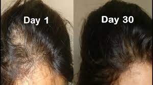 The best way to use onion juice for hair growth is to simply use its raw solution on the scalp or by just drinking 2 to 3 tablespoons every day. Onion Juice For Hair Regrowth Get Long Hair With Onion Hair Oil Amla Hair Oil Youtube