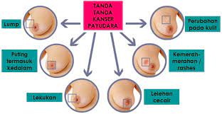 Kondisi penuaan, hormon, dan faktor lain juga bisa. Bendung Kanser Payudara Sebelum Merebak Ke Organ Lain