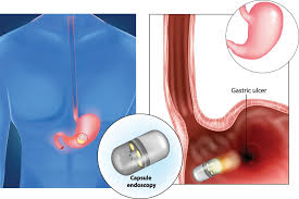 Image result for Wireless Capsule Endoscopy
