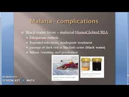 Falciparum is the most prevalent malaria parasite on the african continent. Parasitology 075 I Plasmodium Falciparum Malaria Complication Malignant Black Water Fever Algid Youtube