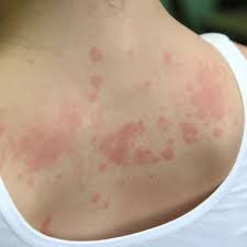 Image result for Contact Dermatitis