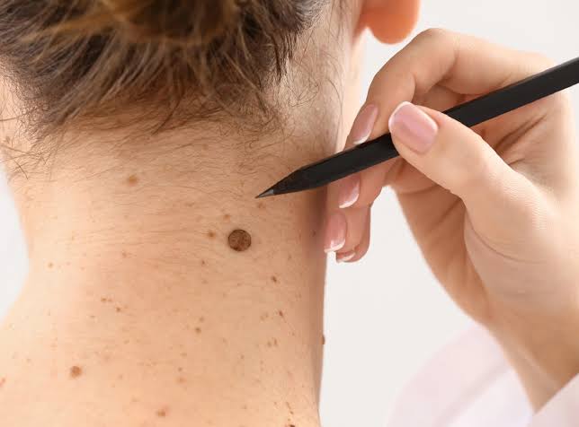Saying Goodbye To Moles: Exploring Modern Removal Trends - Perfect Doctors  Clinic