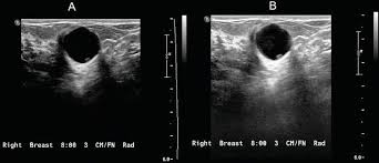 When you see something on ultrasound, you don't have to run. Breast Ultrasound Past Present And Future Intechopen