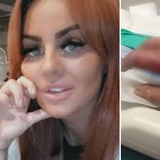 Mum may need skin graft after being burnt by sparklers that caught fire