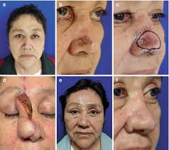 Fundamentals of Basal Cell Carcinoma