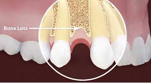 Ảnh hưởng của bệnh loãng xương đến răng | BvNTP