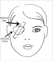Bell S Palsy Sunnybrook Hospital This image helps to show that difference. bell s palsy sunnybrook hospital