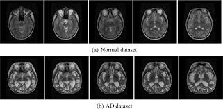 + main factors that influence prices. Automated Detection Of Alzheimer S Disease Using Brain Mri Images A Study With Various Feature Extraction Techniques Springerlink