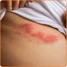 Image result for zoster under breasts