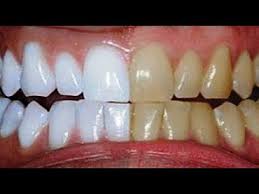 Come Sbiancare I Denti Unendo Al Dentifricio Due Ingredienti Naturali Chiaramonique Youtube Sbiancamento Naturale Dei Denti Dentifricio Sbiancare I Denti