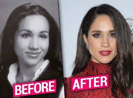 Plastic Princess Meghan Markle Nose Job Exposed By Top Docs Thumbnail Meghan Markle Plastic Surgery Meghan Markle Nose Job Plastic Surgery
