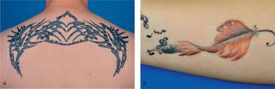 Tattoos Mehr Als Nur Kolorierte Haut Auf Der Suche Nach Tattoo Allergenen Weiss 2021 Jddg Journal Der Deutschen Dermatologischen Gesellschaft Wiley Online Library