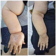 Lenfodem Tedavi Edilebilen Bir Uzm Dr Ahmet Ozcan Kizilkaya Facebook