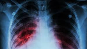 El camino tras el trasplante pulmonar', organizado por la. Medicina Digital Fibrosis Pulmonar Idiopatica Una Rara Enfermedad Que Puede Robarte El Aliento