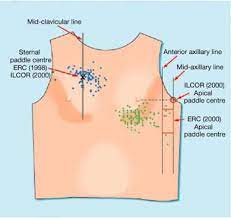 Defibrillation is a process in which an electrical device called a defibrillator sends an electric shock to the heart to stop an arrhythmia resulting in the return of a productive heart rhythm. Electrical Therapies Anesthesia Key