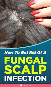Pin On Scalp Treatment Diy