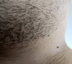More commonly known as razor bumps, this group of little bumps is common on the beard area after you've shaved, waxed. Consistent Irritation Ingrowns How Can I Deal With This Patch Of Neck Hair Wicked Edge