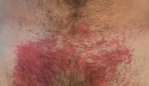 Image result for dermatitis contacta allergica